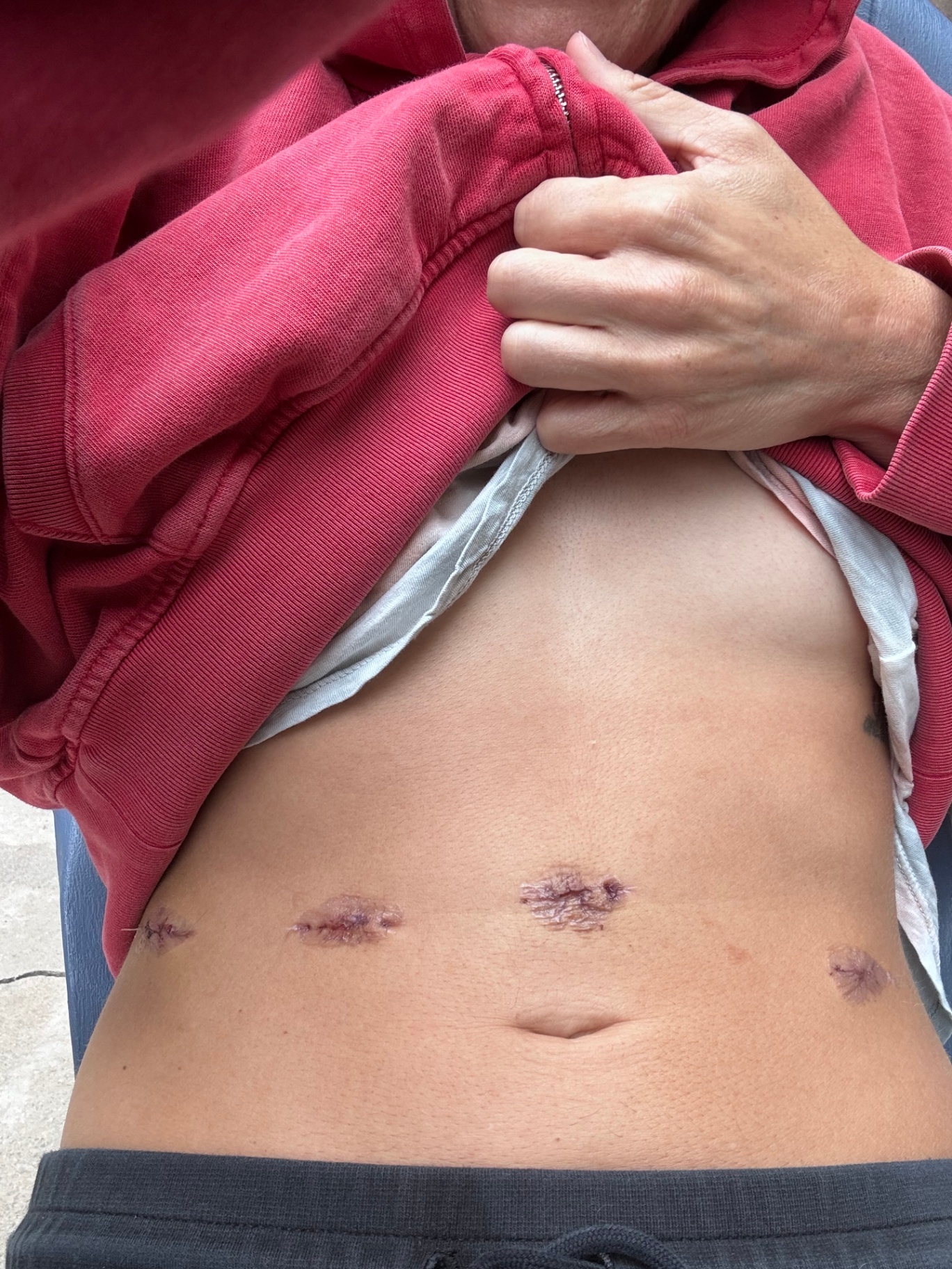 Recovery, after Lauren's hysterectomy